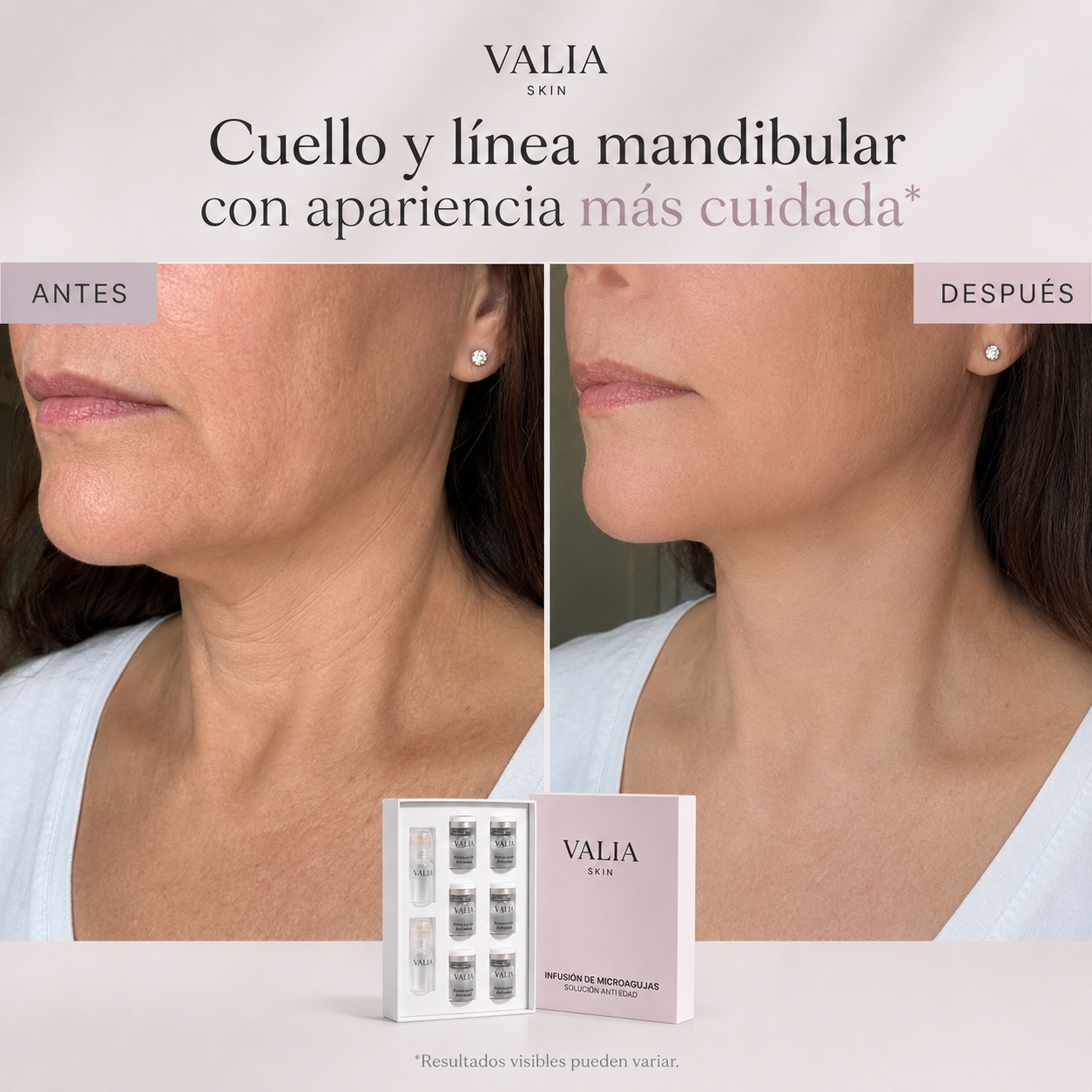 VALIA™ Tratamiento Microagujas Anti Edad