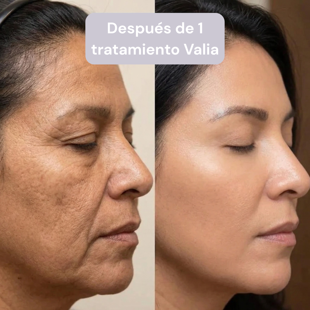 VALIA™ Sistema de Microinfusión Anti Edad